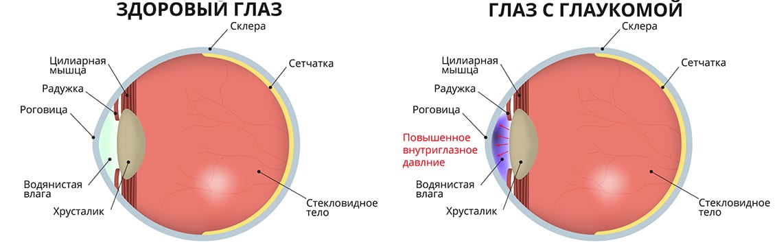 Хирургия глаукомы