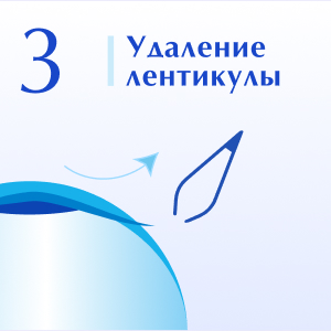 Удаление лентикулы Удаление лентикулы